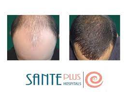 Spitali “Sante Plus” e mashtron/ Shkon të mbjellë flokë, por i “qethin” Lekët!